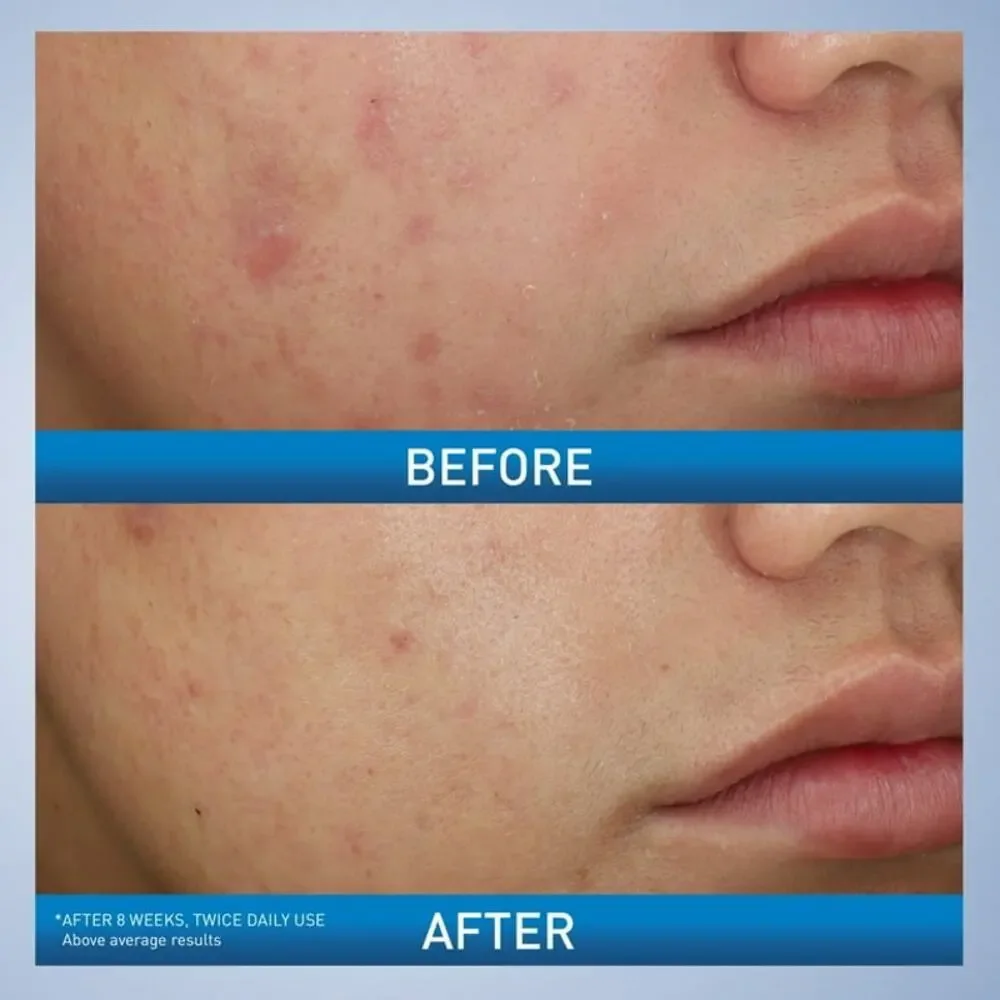 NEW Cerave Acne Foaming Cream Wash 10 Benzoyl Peroxide Max Strength Face Cleaner